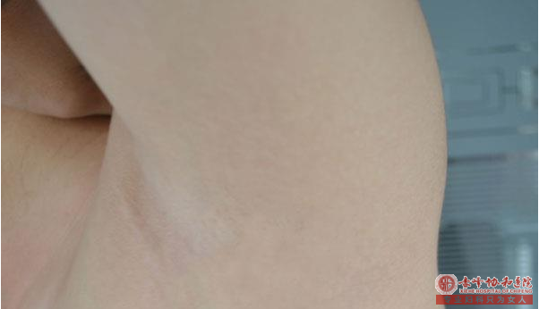 大连做腋臭手术多少钱？