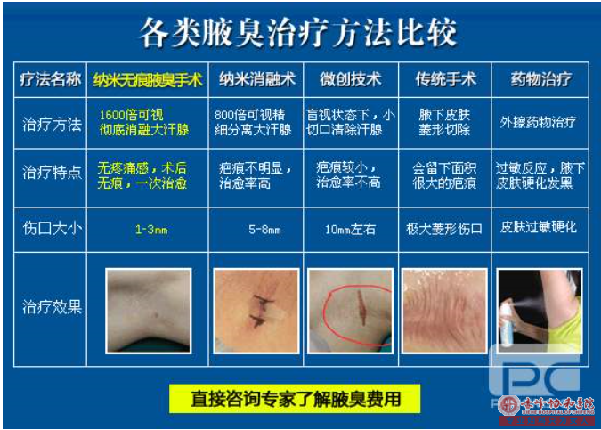 阿鲁科尔沁旗腋臭能根治吗？